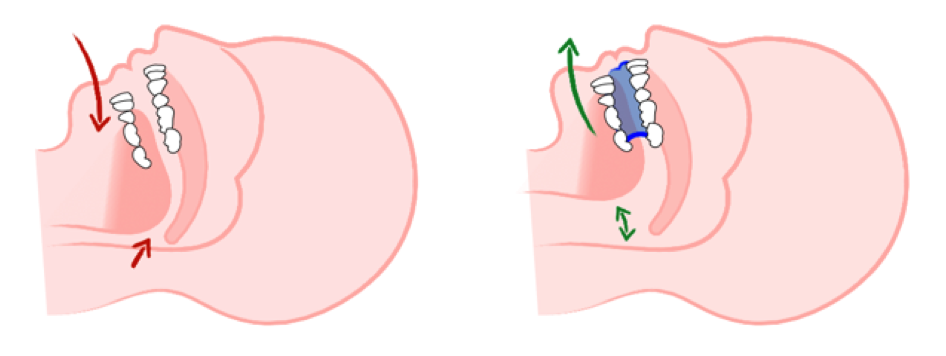 Links: Verengung der Atemwege durch erschlafftes Weichgewebe; rechts: Spannung des Weichgewebes durch die „Schnarcher-Schiene“